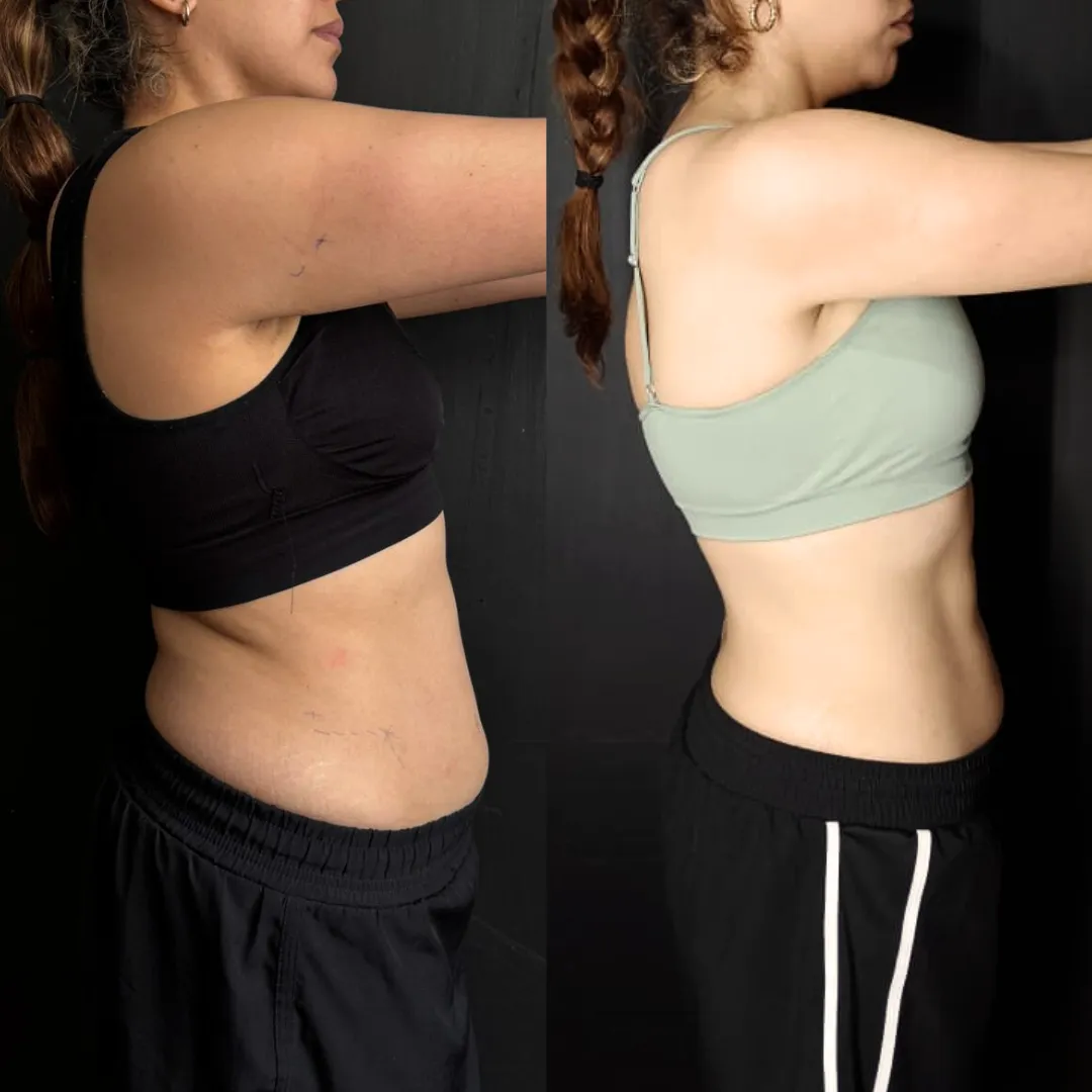 Antes y después — mujer 3
