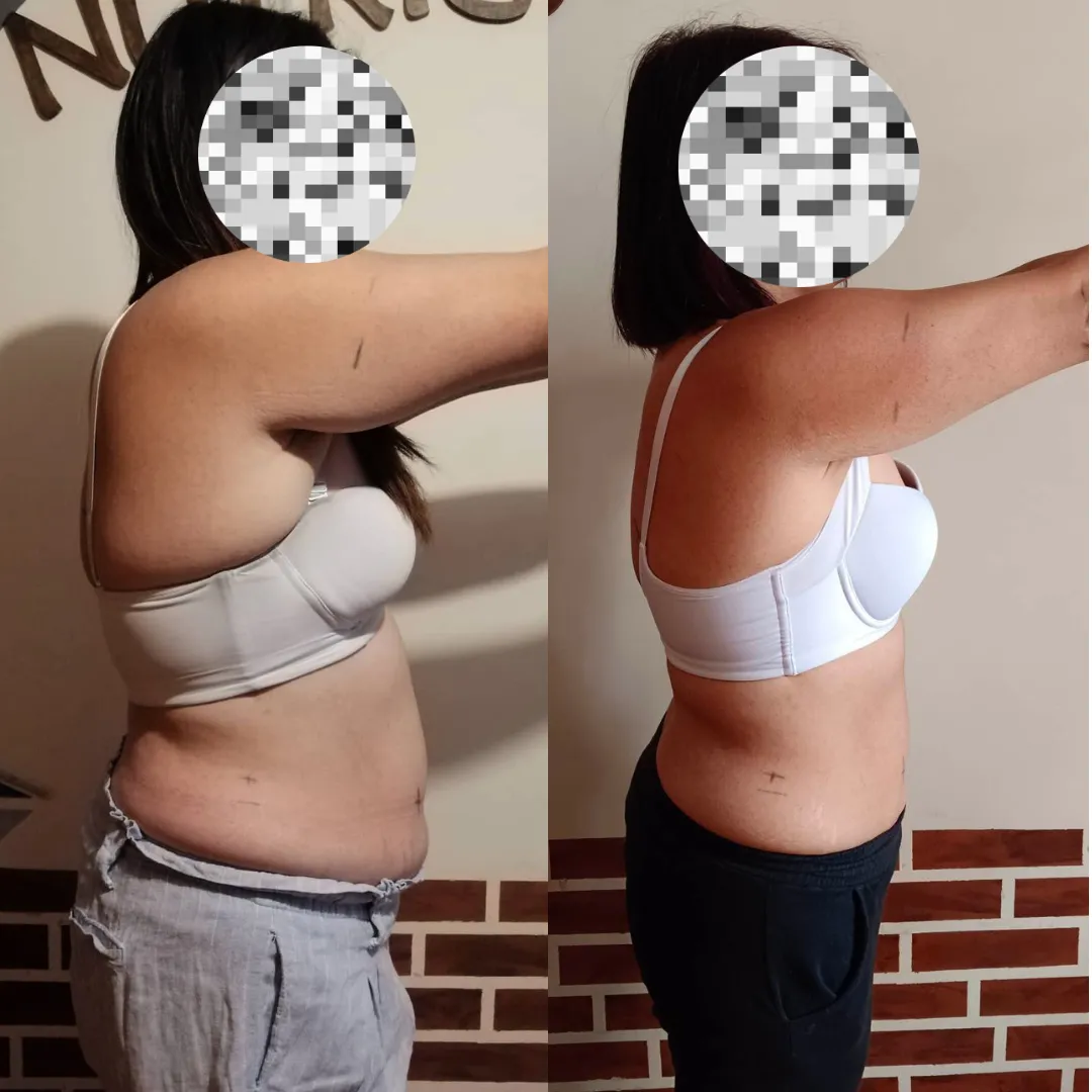 Antes y después — mujer 5