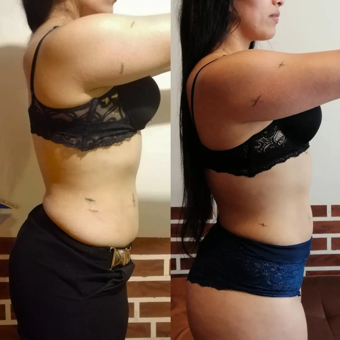 Antes y después — mujer 9