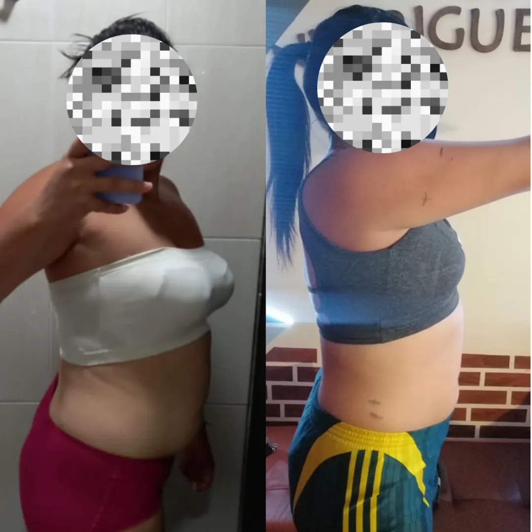 Antes y después — mujer 10