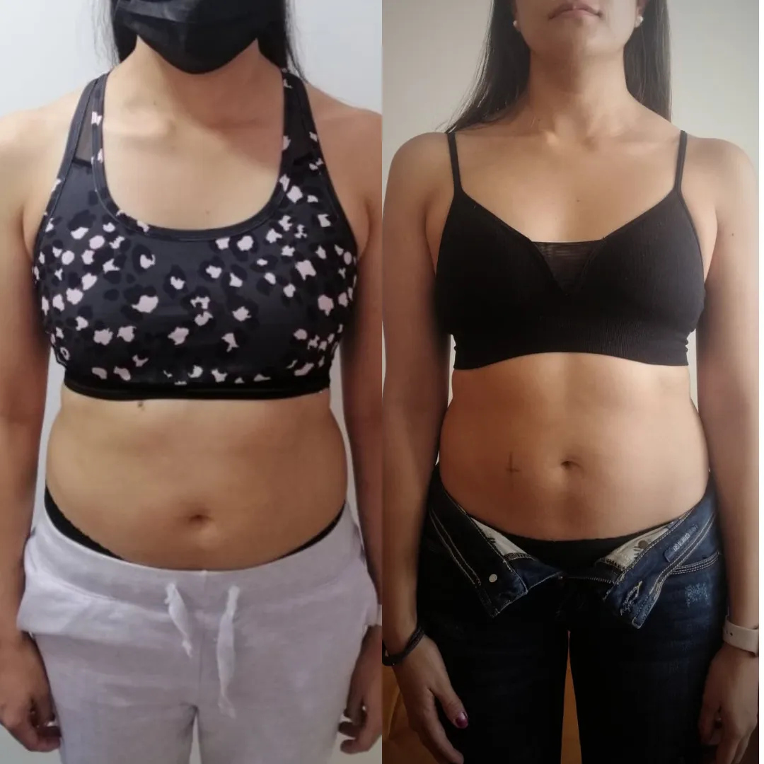 Antes y después — mujer 11