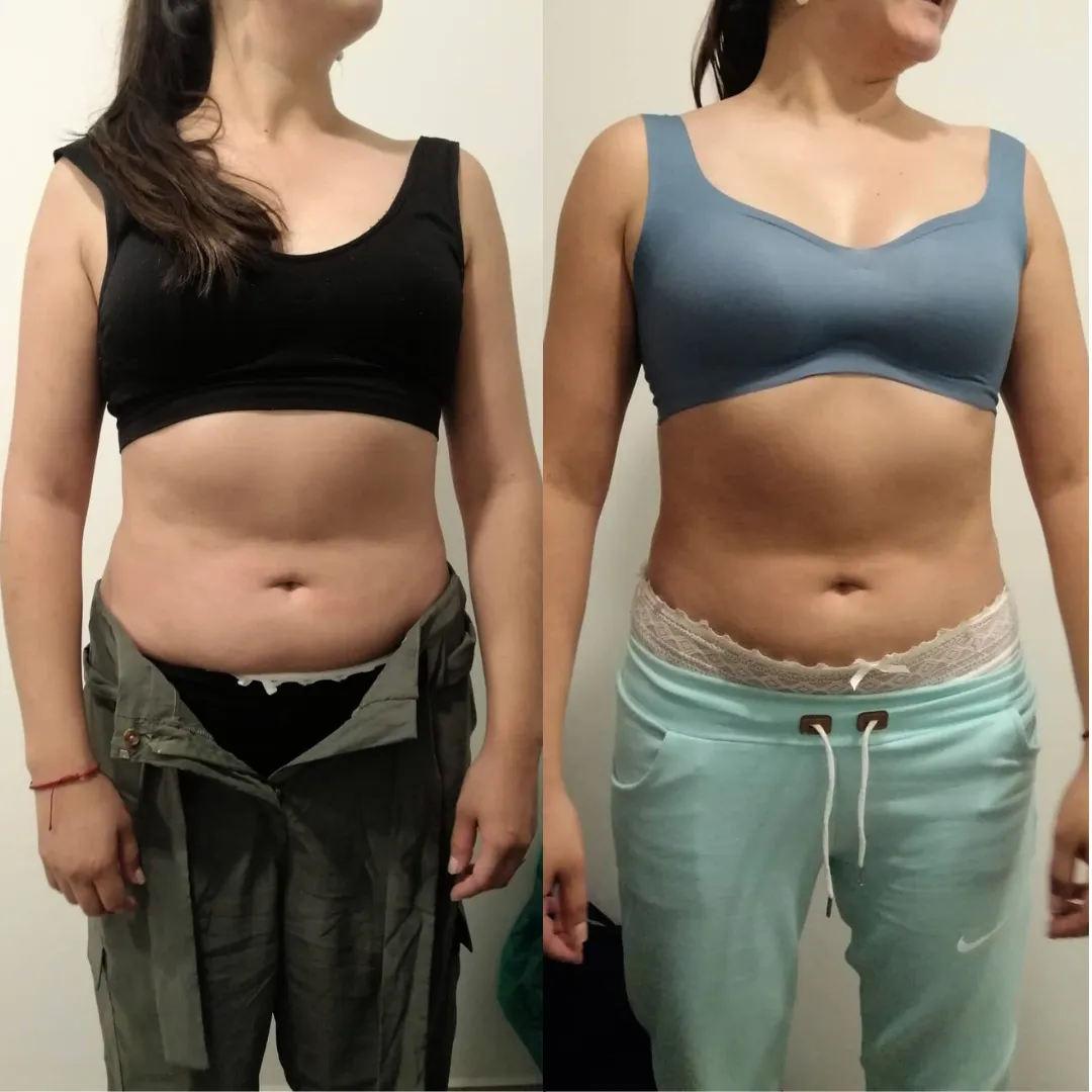 Antes y después — mujer 15